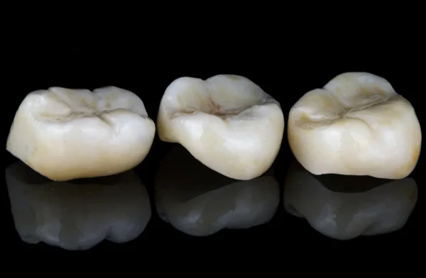 Dental Crowns in Kidbrooke in Kidbrooke