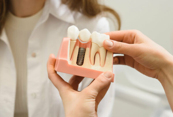 Dental Implants in Kidbrooke in Kidbrooke
