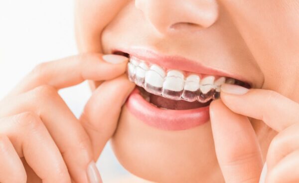Invisalign® Lite in Kidbrooke in Kidbrooke