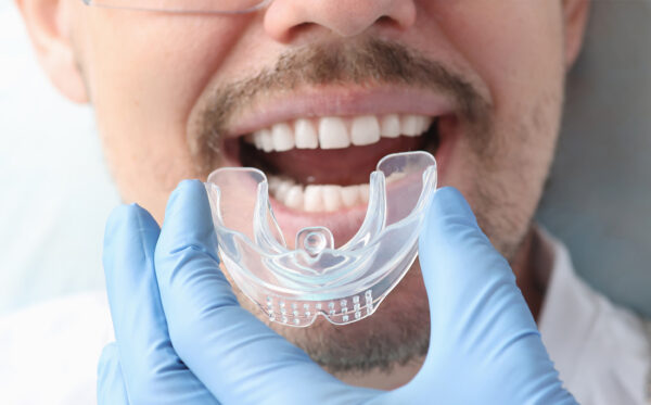 Custom Mouth Guards in Kidbrooke in Kidbrooke