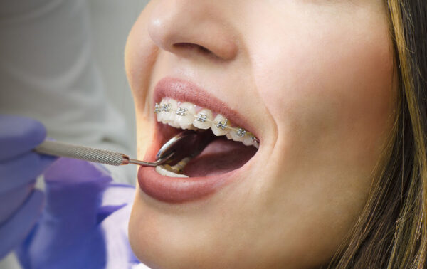 Orthodontics in Kidbrooke in Kidbrooke