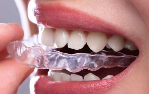 Invisalign® i7 in Kidbrooke in Kidbrooke